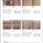 Professional Germany Laser Tan Removal Machine/skin Type Mongolian Spots Removal Vertical Nd Yag Laser Hair Removal Machine Q Switched Nd Yag Laser Tattoo Removal Machine