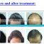 wholesaler wanted instant hair growth and medical infrared laser therapy device