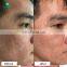 2022 skin rejuvenation led light  skin rejuvenation laser machine