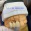 Expander Orthodontic in China Dental Lab
