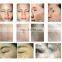4D pro 1064nm laser 2940nm erbium laser oral treatment skin resurfacing machine