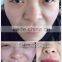 spot removal machine , freckle removal machine $260/pcs ,without shipping