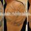 Shanghai Apolo ISO CE portable q switch laser tattoos removal machine