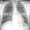 35*43cm Agfa films DT2B made in china for hospital agfa blue sensitive filmagfa x-ray film