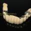 Telesope Crown, Dental Telescope Denture, Dental Prosthesis, Laboratoire Dentaire, Dentallabor, Laboratorio Dental, Dental Laboratory, Shenzhen LJ Dental Lab China