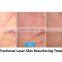 Spot Scar Pigment Removal Fractional Co2 Laser Equipment/co2 8.0 Professional Inch Fractional Laser Machine Eye Wrinkle / Bag Removal