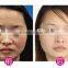 new laser hair removal set with Alexandrite 755nm to reach magic result