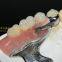 Dental precision attachment, dental attachment, dental denture, laboratoire dentaire, Dentallabor, laboratorio dental, dental laboratory, Shenzhen LJ dental lab China