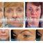 HIFU-C hifu iso radio frequency ultrasound face lift hifu face lift 7 cartridges