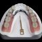 Metal crown/bridge  Chinese denture manufacturer