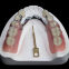 3d print PFM denture & false teeth