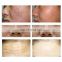 2022 facial beauty   rotating hydradermabrasion  facial equipment beauty hydradermabrasion solution