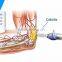 Shock Wave Slimming for tissue skin removal