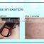 hyperplastic scar removal, co2 fractional laser