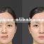 Metal Laser Spot Skin Mole Removal Machine With 12pcs Needles