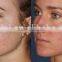 Spot Scar Pigment Removal Fractional Co2 Fractional Laser Vaginal Tightening Medical Treat Telangiectasis & Acne Scar Removal Machine CO2 Laser Skin Renewing