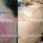distributor low price ! 980nm spider vein removal machine vascular remover 980 varicose vein laser