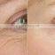 2016 factory machine wholesale Radio frequency wrinkle removal face lift skin rejuvenation and acne scar clearance