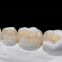 Dental Porcelain Gold Crown/Precious metal Crown China Outsourcing Dental Lab