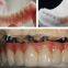 REMOVABLES | DENTURES Premier Denture  Dental Lab, Dental Implant, Crowns