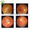 Hand Held non-mydriatic Digital Fundus Camera