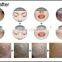 Laser tattoo removal