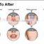 ipl shr laser machine hair removal & skin rejuvenation with shr 1550 handle for fast hair