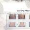 Weight loss dual wavelength lipolaser