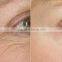 RF fractional micro needle / fractional rf wrinkle removal machine / fractional rf