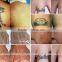 Totally Metal Case Q Switch Laser for Skin Disease Treatment