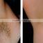 Hottest!!!Spa Elight+SHR+IPL fast hair removal laser machine with OEM/ODM