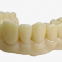 What Is A Dental Bridge?Dental Lab Crown and Bridges