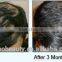 3600USD most effective diode laser hair regrowth machine low level laser therapy hair loss laser cap for hair growth