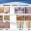 Advanced 808nm Diode Laser Permanent Hair Removal Beauty Equipment&machine