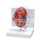Pathological Medical Human Body Anatomy Model Kidney