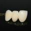 Dental crown zirconia PFZ, dental teeth, dental prosthesis, laboratoire dentaire, Dentallabor, laboratorio dental, dental laboratory, Shenzhen LJ dental lab China
