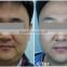 Best face lift hifu beauty machine CE approved anti-aging wrinkles machine