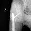 Medical mobile x ray equipment PLX5200A