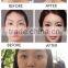 Hot Sale Acne care blue light acne therapy
