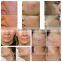 Facial Muscle Stimulator Fractional RF skin tightening rf microneedle electric wrinkle remover machine