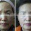 Low price 3 head pieces hifu face machine anti-aging machine