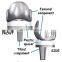 Best Quality Total Knee Replacement System
