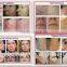 Mongolian Spots Removal China Factory Provide Cheapest Tattoo Removal System Yag Laser Tattoo Removal Machine Permanent Tattoo Removal