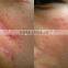 Skin Regeneration Professiobal And Stable Co2 Fractional Laser Machine With Glass 40w Tube America Metal RF Tube And China Metal RF Tube For Choose