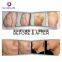 Popular Products Ultrasonic Cavitation Rf Lipocavitation Slimming Machine