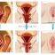 Professional inner vulva firming maintenance non-invasive hot-lifting RF vaginal rejuvenation machine