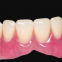 Dental Crown E.Max Ceramic, Porcelain Teeth, Dental Veneers, Laboratoire Dentaire, Dentallabor, Emax