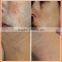Laser Vascular Therapy Red Spider Veins Removal Machine /Removal of spider veins