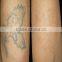 Laser Beauty Equipment Series Q Switch Nd Yag Q Switched Laser Machine Laser Tattoo Removal Machine Tattoo Laser Removal Machine