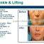 2016 factory machine wholesale Radio frequency wrinkle removal face lift skin rejuvenation and acne scar clearance